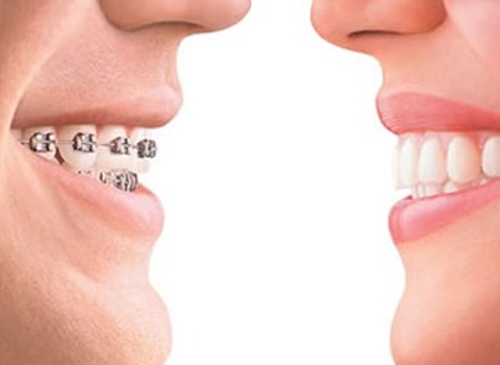 Invisalign -Telsiz Ortodonti